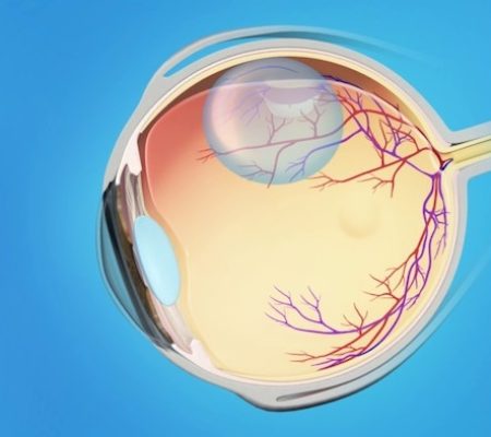 Retina Dekolmanı
