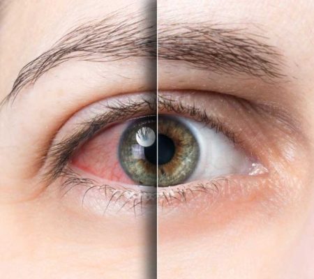 Retina Kanamaları